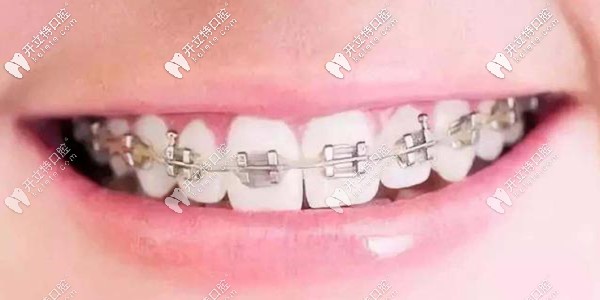 自鎖托槽矯正器