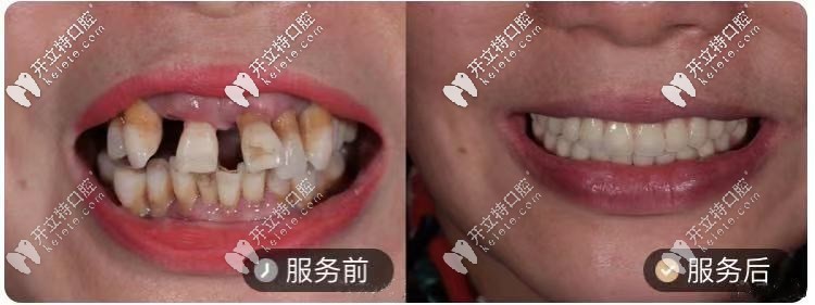 50歲阿姨，做的ALL-ON-4種植牙對(duì)比圖