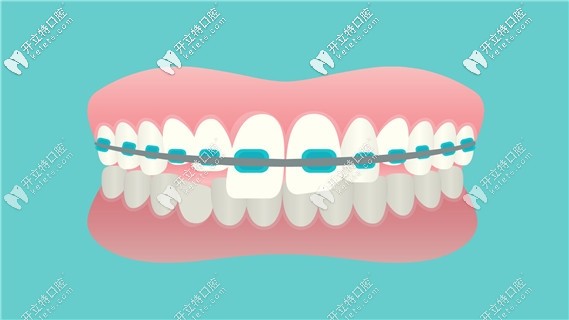對比lh魔線絲矯正和mbt直絲弓矯正
