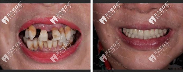 長沙牙祖口腔周磊種植案例二