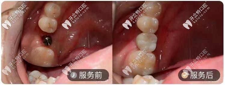 在長沙牙祖口腔做的1顆韓系種植牙對(duì)比圖