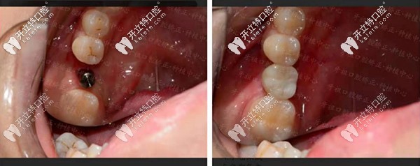 長沙牙祖口腔周磊種植案例一