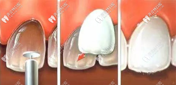 做一口全瓷貼面大概得多少錢，打算去做16顆超薄牙貼面