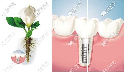 國產(chǎn)和韓系種植牙如登騰奧齒泰哪個較便宜？4000塊就能種的