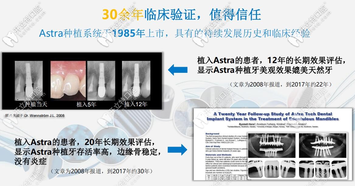 瑞典astra種植牙壽命高不高有論證的