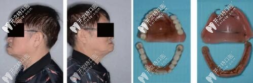 【病例分享】韓國奧齒泰種植體做全口桿卡式覆蓋義齒修復(fù)