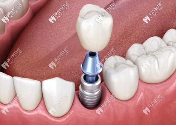 將我在廣州天河區(qū)盛康苑口腔種植一顆大牙的經(jīng)歷,分享出來