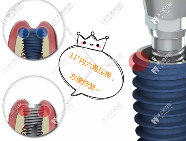 韓國anyone藍色種植牙的價格