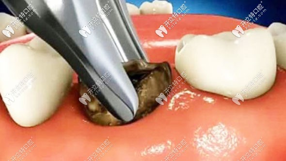 我20歲做種植牙的經(jīng)歷