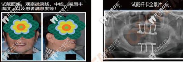 韓國奧齒泰種植體做全口桿卡式覆蓋義齒修復(fù)案例