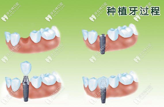 種植牙過程演示圖