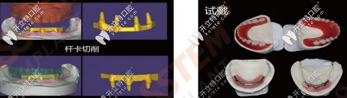 全口桿卡式種植牙手術(shù)過程