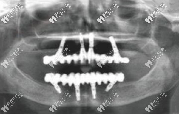 深圳爾睦口腔種植牙怎么樣 深圳爾睦口腔種植牙怎么樣