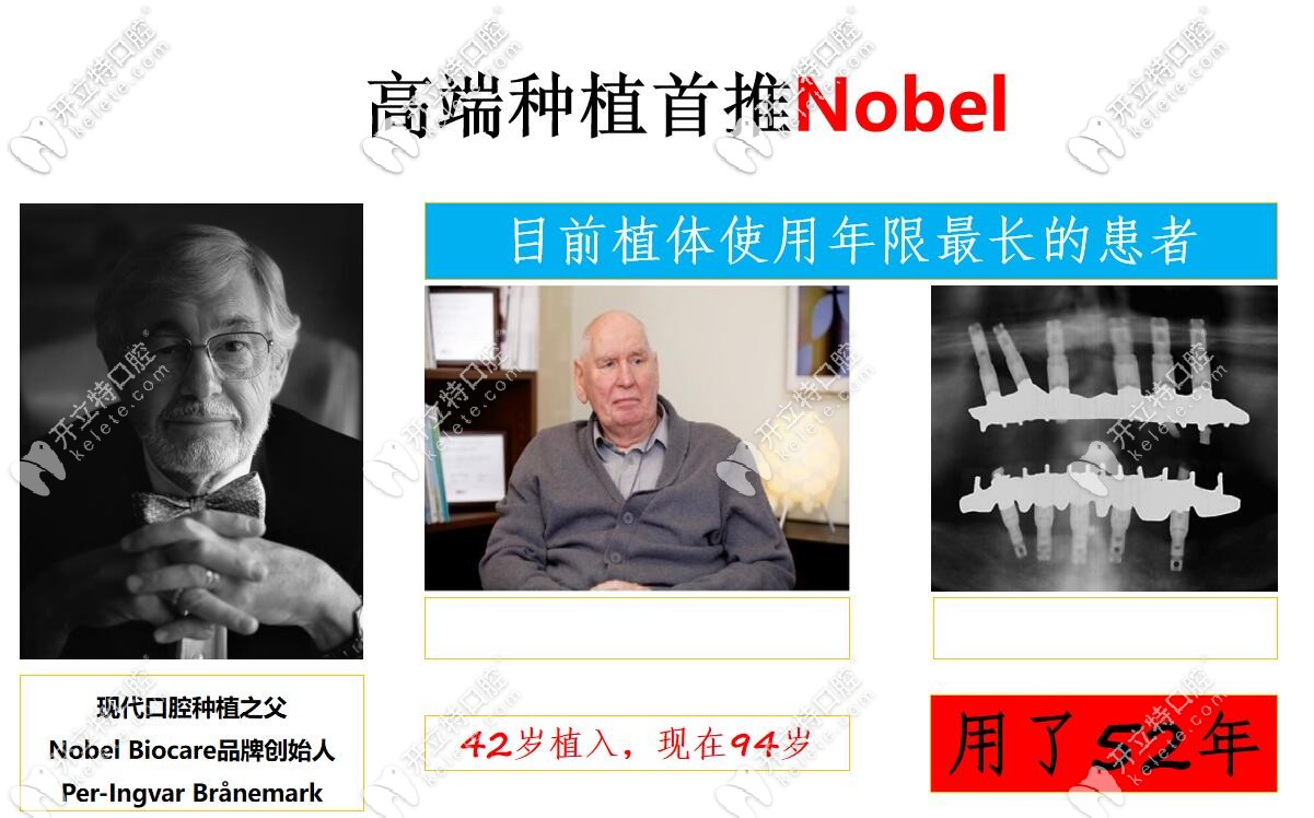 諾貝爾種植體的使用壽命