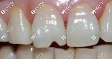 常吃堅(jiān)果會(huì)加速牙齒的磨耗，使牙齒出現(xiàn)裂紋