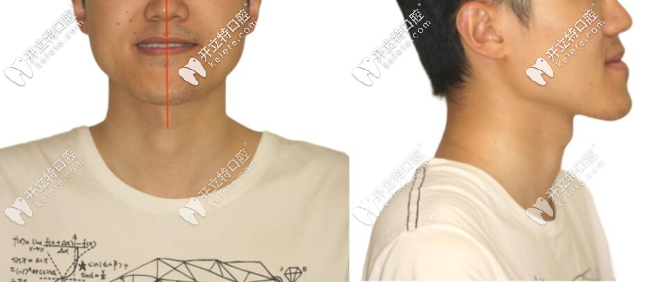 地包天小哥哥矯正前正側(cè)面照 地包天小哥哥矯正前正側(cè)面照