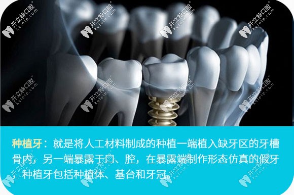 在我們廣州新塘華醫(yī)口腔做一顆韓國(guó)登騰種植牙花了7千多元