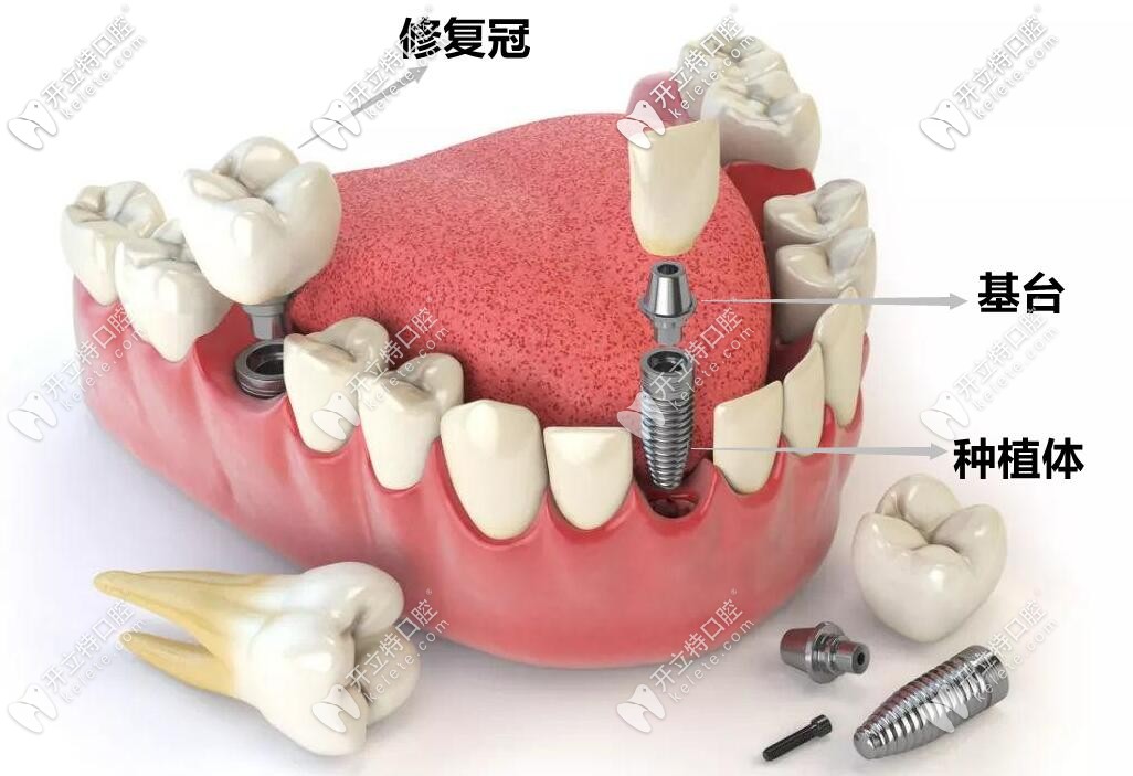 種植牙的結構圖展示