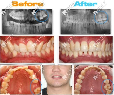大牙缺失通過(guò)正畸,智齒前移代替磨牙的成功案例分享