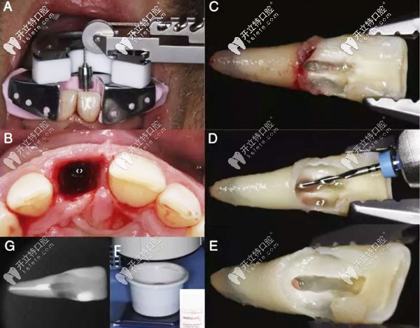意向性再植術(shù)過(guò)程圖解