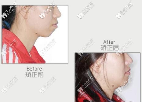 正畸智齒代替7號牙案例