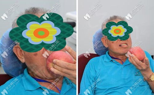 深圳麥芽口腔下半口架橋式種植牙<span style=