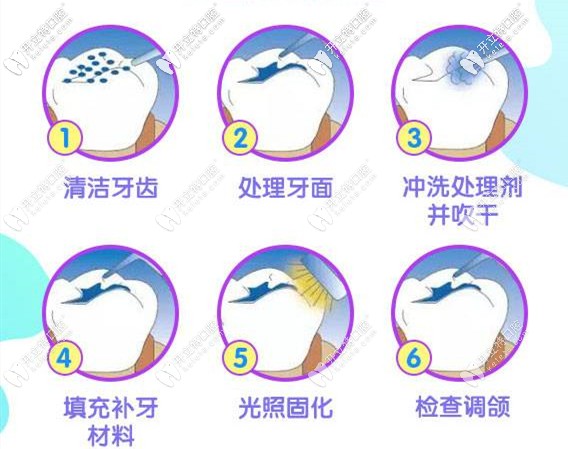 補(bǔ)牙的流程