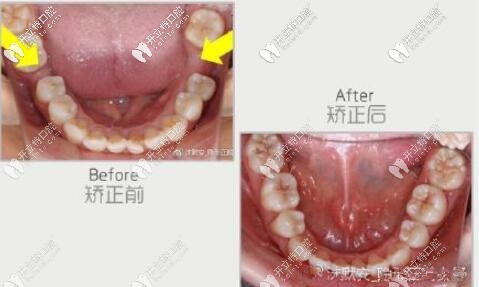 智齒前移當(dāng)磨牙