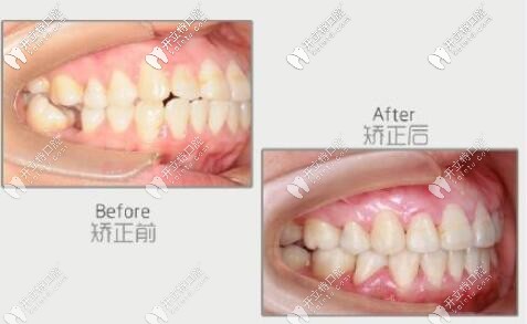 智齒代替大牙矯正案例