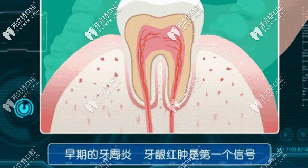 早期牙周炎，牙齦紅腫是個信號