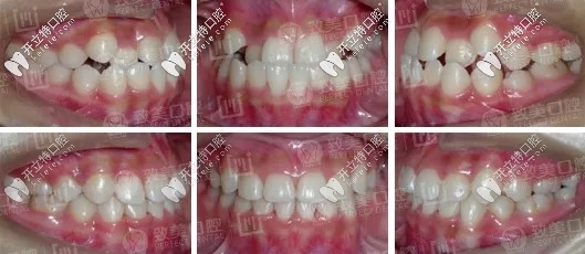  反頜牙列擁擠矯正前后對(duì)比