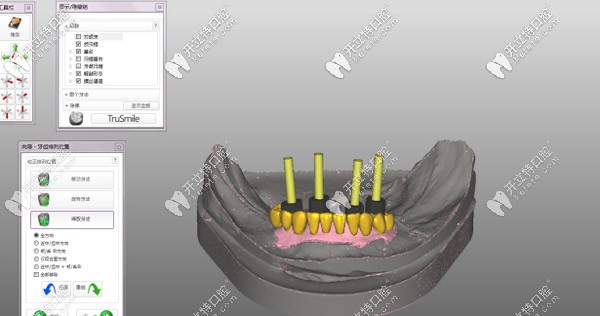 種植桿卡要先進(jìn)行CAD設(shè)計