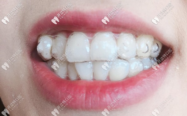 在廣州做國產或進口隱形矯正的費用