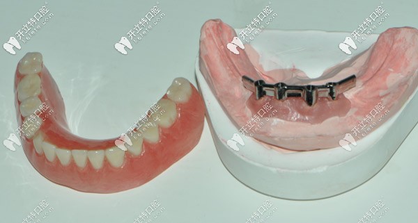 桿卡在牙齒模型上就位