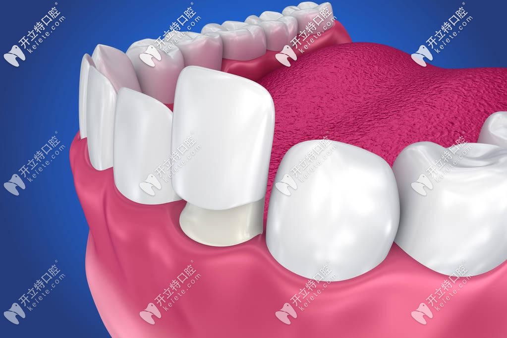 武漢做牙齒貼面技術比較好的醫(yī)院都在這了,還有瓷貼面價格