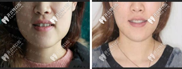 矯正前后對比圖二