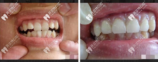 矯正前后對比圖三