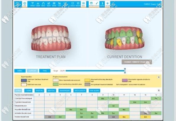 來認識下-隱適美itero口掃儀or丹麥3shape口腔掃描的區(qū)別吧