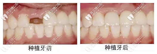 德柏口腔種牙前后對(duì)比
