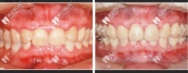深覆合隱適美隱形矯正前后對(duì)比