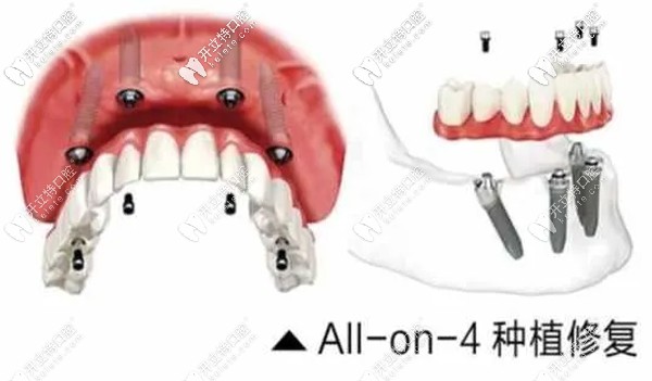 ALL- on-4種植牙技術(shù)