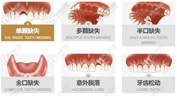 種植牙的適應癥狀