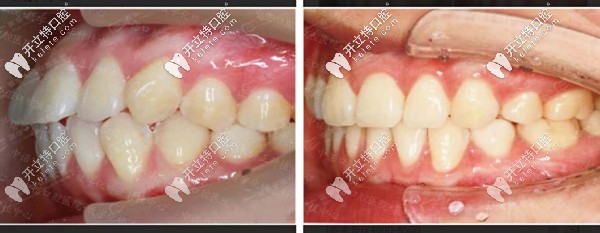 牙齒前凸時(shí)代天使隱形矯正前后對(duì)比