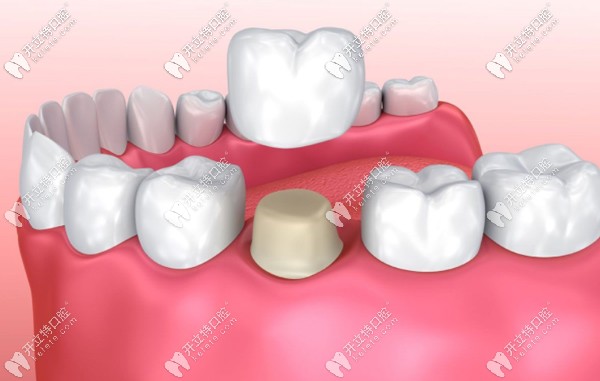 朔州做烤瓷牙的參考價格