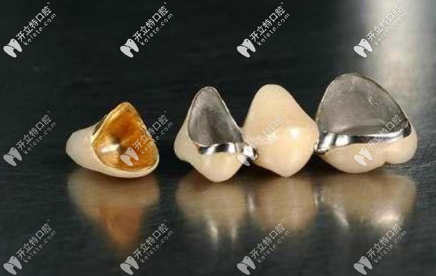 烤瓷牙600和800元、1200塊的區(qū)別在哪？價(jià)格貴質(zhì)量就好？