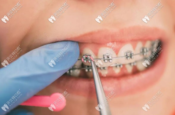 黃濤醫(yī)生擅長(zhǎng)各類牙齒正畸技術(shù)