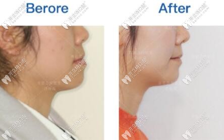 北京禾禾齒科張棟梁教授做骨性地包天矯正的案例匯總