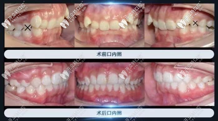 長沙美奧口腔：熊安鳳醫(yī)生的復(fù)雜案例圖