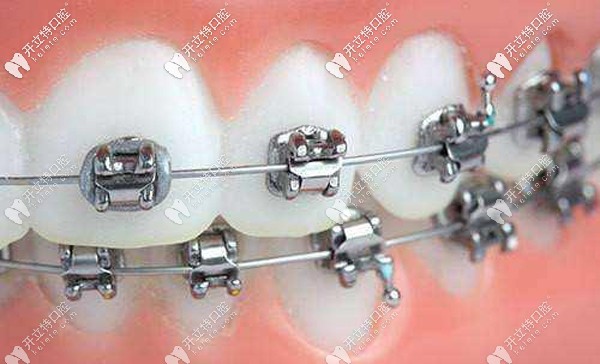 金屬自鎖托槽矯正