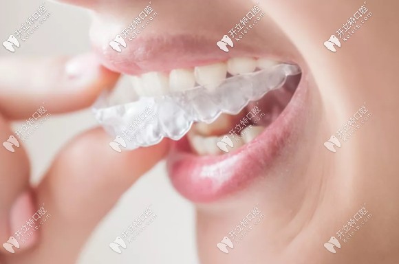 王釗偉醫(yī)生淺析隱適美和時代天使及正雅的優(yōu)勢